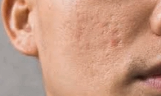 Sinchon Acne Scars: How They Are Treated by Type image 3