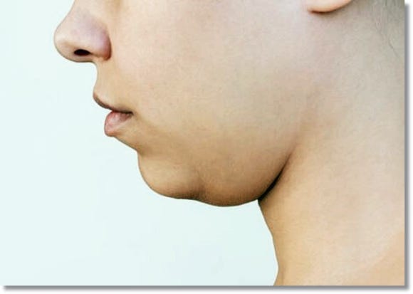 The Truth and Myths About Cheek Hollowing After Vero Lifting image 5