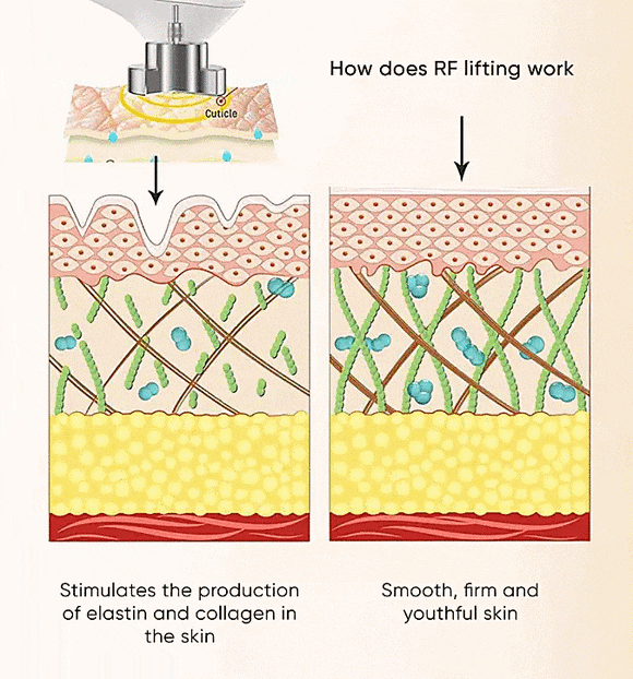 Hongdae Density Lifting: The Core Principles of RF Laser and Firming Effects image 2