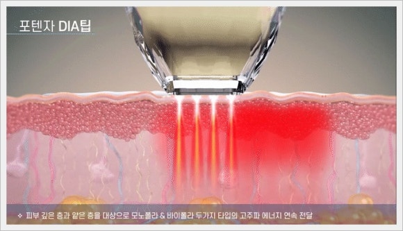 포텐자 다이아리프팅 다른 고주파 리프팅과 어떻게 다를까? 관련 이미지 3