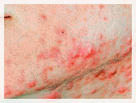 Sinchon Acne Dermatology Clinic: Why Treatment Order Matters image 2