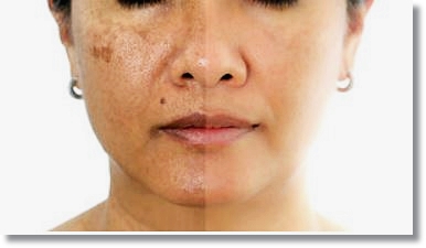 Worried About Scarring and Recurrence After Mole Removal in Hongdae? image 2