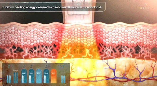 Hongdae Entrance Dermatology Clinic: If You Want to Improve Skin Elasticity image 6