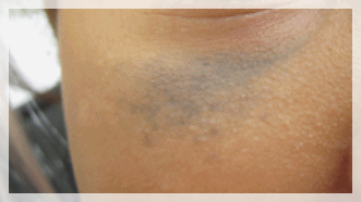 Sinchon Pico Toning: What to Check Before Considering Its Effects image 7