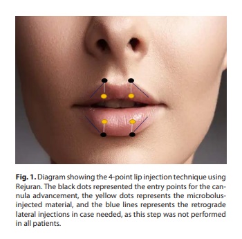 What Effects Can You Expect from Lip Rejuran? image 3