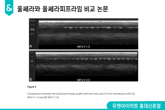 Hongdae Ulthera Prime Effects: Has the Precision Changed? image 3
