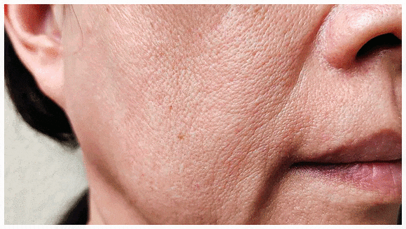 Hongdae InMode: Why the Effects of Forma and FX Must Be Properly Distinguished When Choosing Treatment image 5