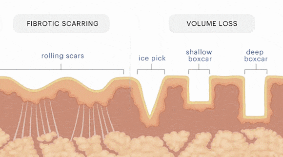 Hongdae Acne Dermatology: Can You Recover Smooth Skin Without Scarring? image 3