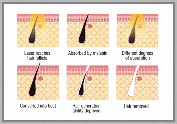 Sinchon Laser Hair Removal: Why a 5-Session Package May Not Be Enough image 2