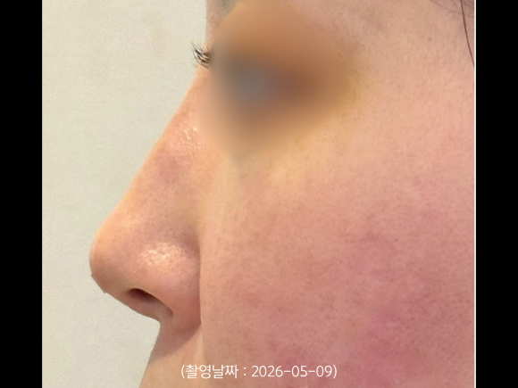A Case of Correcting a Hump Nose with HiCo Thread Lifting in Hongdae image 4