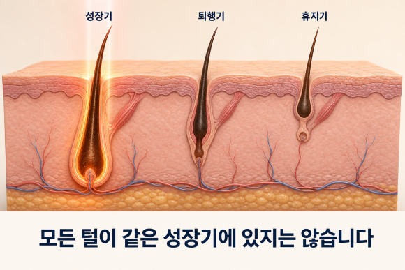 홍대 겨드랑이제모, 몇 번 받아야 하는지 솔직하게 얘기한다면? 관련 이미지 2
