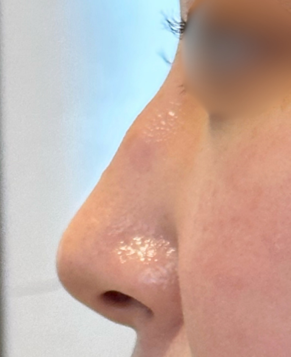 A Case of Correcting a Hump Nose with HiCo Thread Lifting in Hongdae image 1