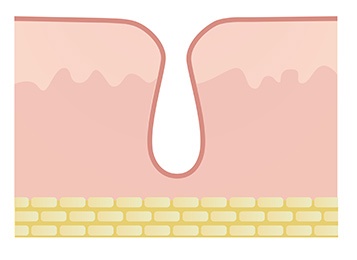 If You’re Worried About Enlarged Pores in Hongdae Potenza, Read This First image 3