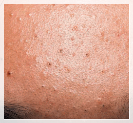 Hongdae Acne Clinic, Why Extraction Alone Isn’t Enough image 4