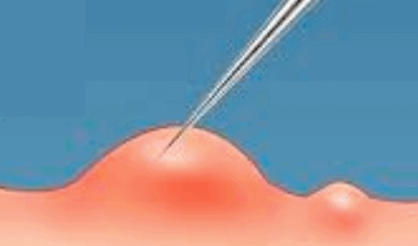 Hongdae Acne Extraction: 3 Things You Must Check image 2