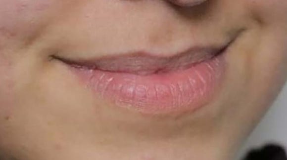 What Effects Can You Expect from Lip Rejuran? image 2
