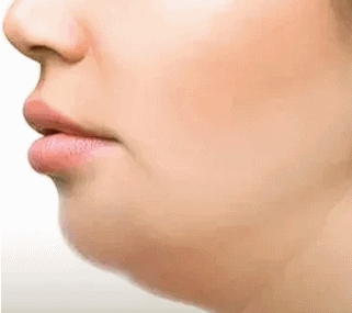 Sinchon Lifting: What Are the Jawline Improvement Effects of Ultherapy Prime? image 1