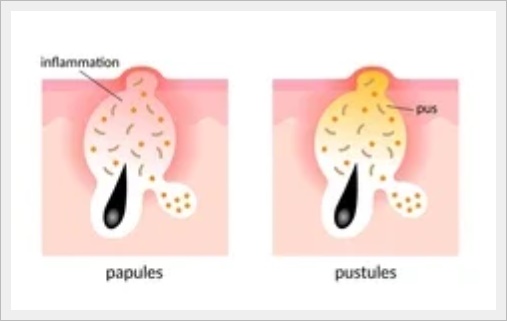 Hongdae Acne Dermatology Clinic: Why You Should First Consider the Stage of Your Acne image 3
