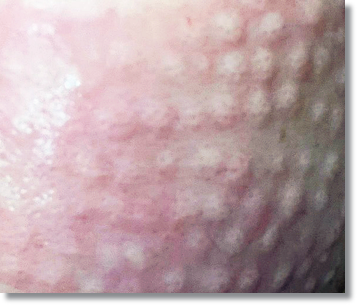 If You Get Sinchon Rejuran With Pain Relief, Does It Really Not Hurt? image 3