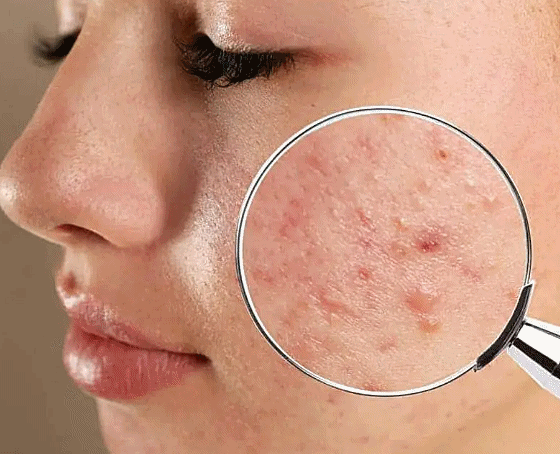 Hongdae Acne Dermatology: Can You Recover Smooth Skin Without Scarring? image 9