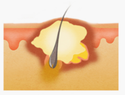 Hongdae Acne Extraction: 3 Things You Must Check image 1
