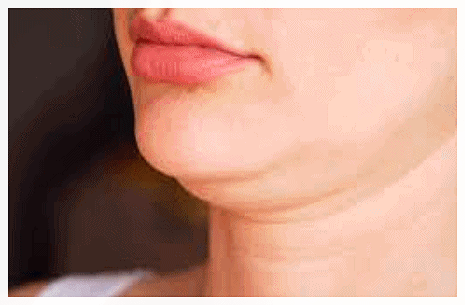 Hongdae InMode: Why the Effects of Forma and FX Must Be Properly Distinguished When Choosing Treatment image 7