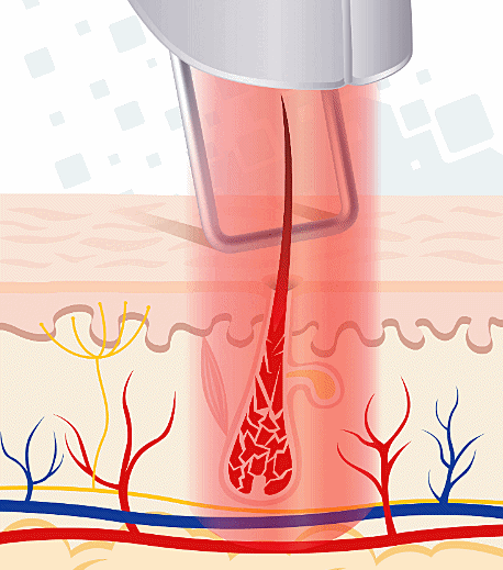 Check the Key Factors That Determine the Effectiveness of Sinchon Laser Hair Removal image 3