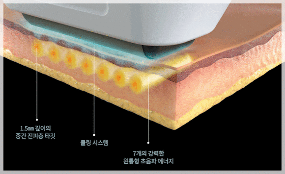 Hongdae Sofwave: How Does It Differ from the Effects of Ultherapy? image 2