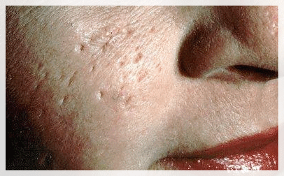 Hongdae Acne Dermatology Clinic: When Is the Right Time to Start Treating Acne Scars in Adolescents? image 6