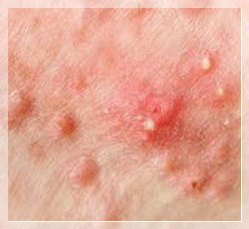 Hongdae Acne Dermatology Clinic: When Is the Right Time to Start Treating Acne Scars in Adolescents? image 4