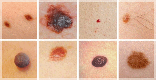 Sinchon Mole Removal: What to Check Before Price or Reviews image 2