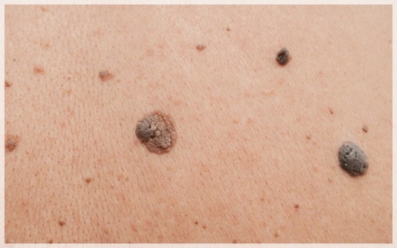How to Avoid Scarring After Mole Removal in Sinchon image 1