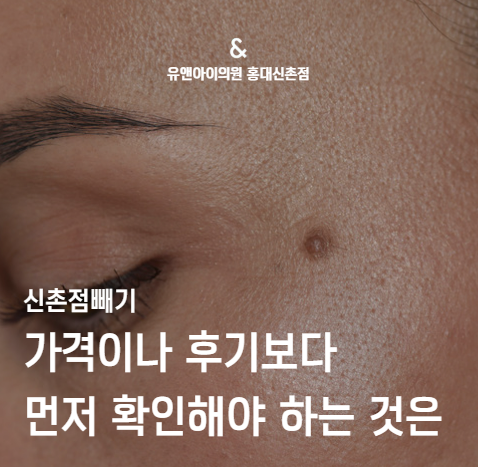 Sinchon Mole Removal: What to Check Before Price or Reviews image 1