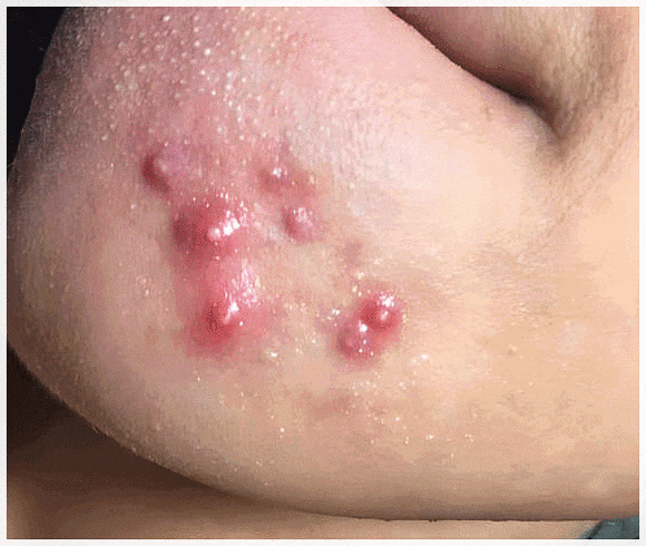 Hongdae Acne Clinic, Why Extraction Alone Isn’t Enough image 1