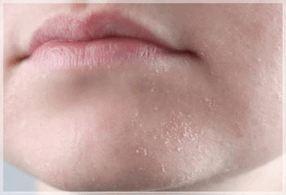 Hongdae Aqua Peel: Is It Suitable for People with Severe Dehydrated Skin? image 10