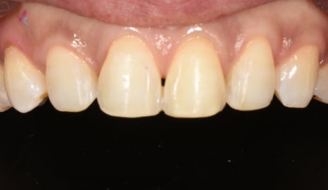 &ldquo;치아 비대칭, 교정 말고 라미네이트로 잡을 수 있을까?&rdquo; 관련 이미지 2