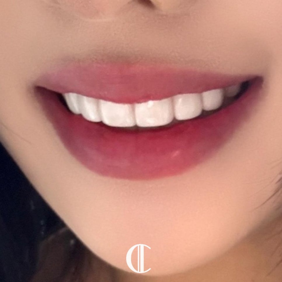 When One-Day Veneers Are Needed and Why Teeth Turn Yellow | Dogok-dong Dental Clinic image 6