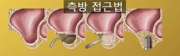 선릉잘하는 치과 상악동 거상술 비용 관련 이미지 3