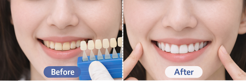 강남 치아 미백 후기｜치아톤만 바꿨을 뿐인데 인상이 달라졌어요 관련 이미지 1