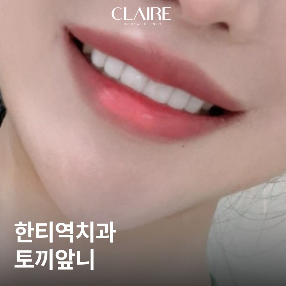 한티역치과 토끼앞니 무삭제라미네이트가격 얼마나 들까요? 관련 이미지 1