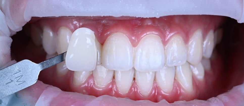 강남치아미백, 디테일이 다른 미백 결과 (선릉 클레어치과) 관련 이미지 1