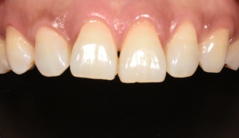 &ldquo;치아 비대칭, 교정 말고 라미네이트로 잡을 수 있을까?&rdquo; 관련 이미지 1