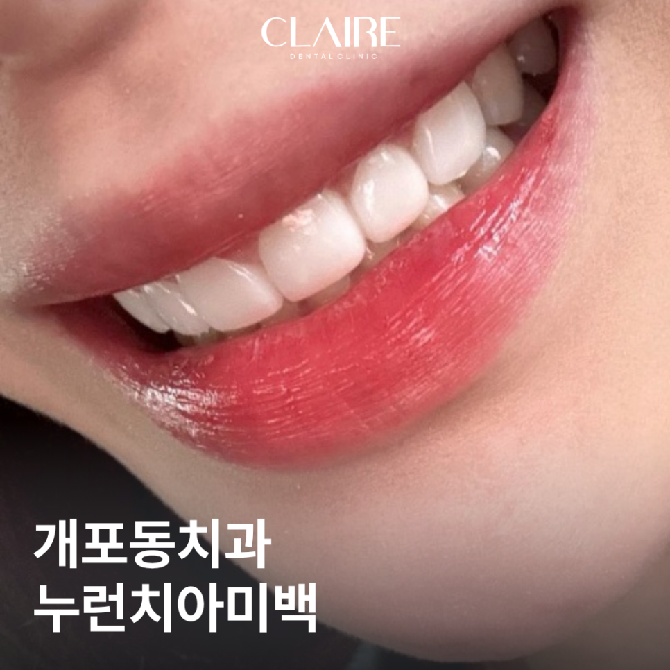 개포동치과 누런이 누런 치아 미백으로 해결 가능할까? 관련 이미지 1