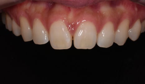 치아 모양이 안예뻐서 속상해요 관련 이미지 1