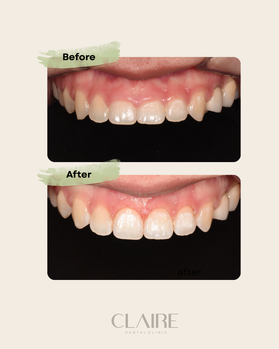 잇몸 성형이 뭐에요? 관련 이미지 1