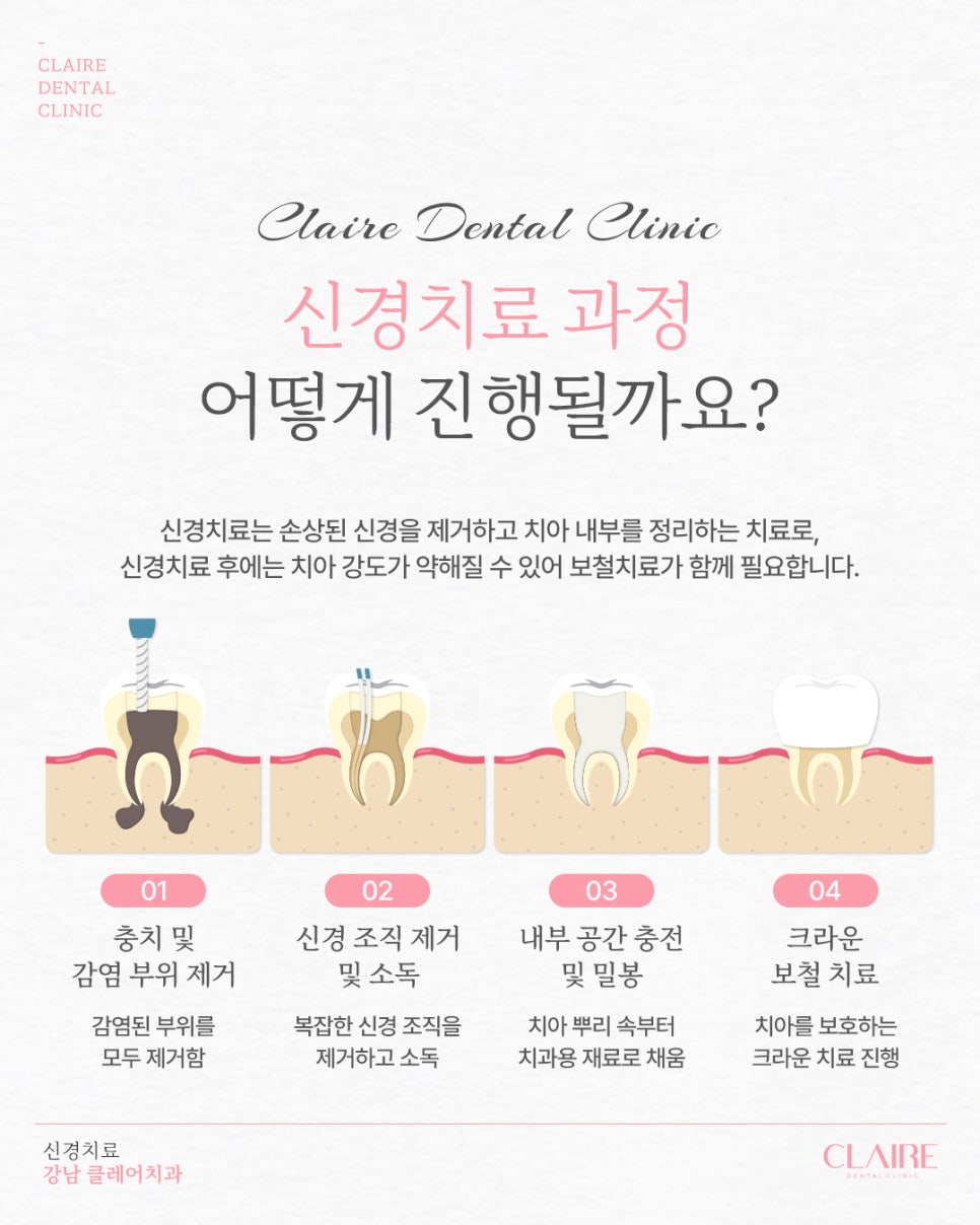 선릉충치치료, 치아를 살리기 위한 마지막 방법 신경치료 관련 이미지 8