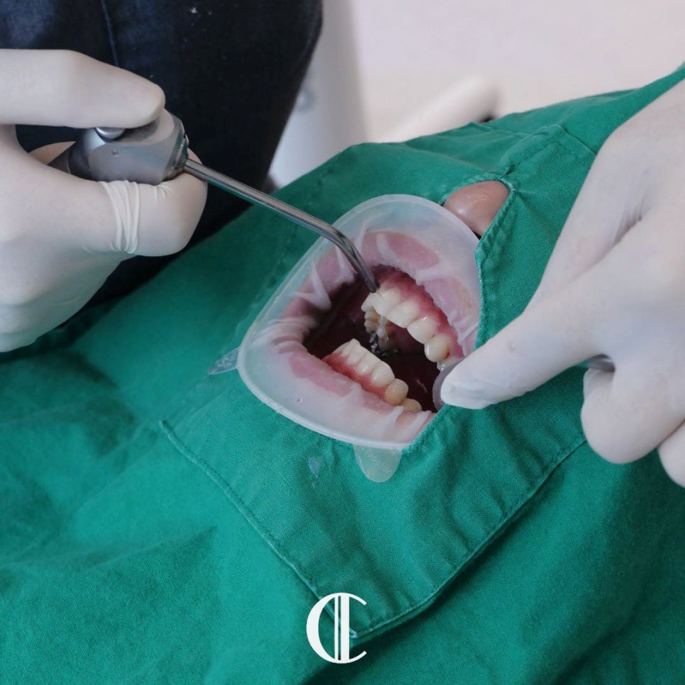 Eonju Station Dental Clinic: For Laminate Veneer Retreatment, Do the Teeth Have to Be Filed Down Again? image 10