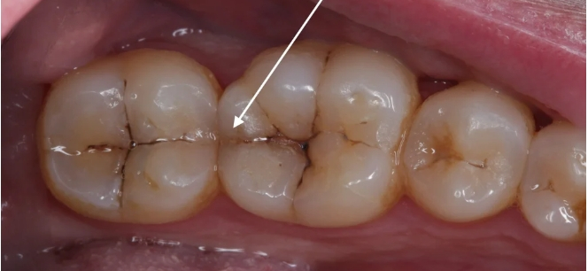 선릉잘하는치과 금이 간 치아(크랙치아)란 무엇인가? 관련 이미지 1