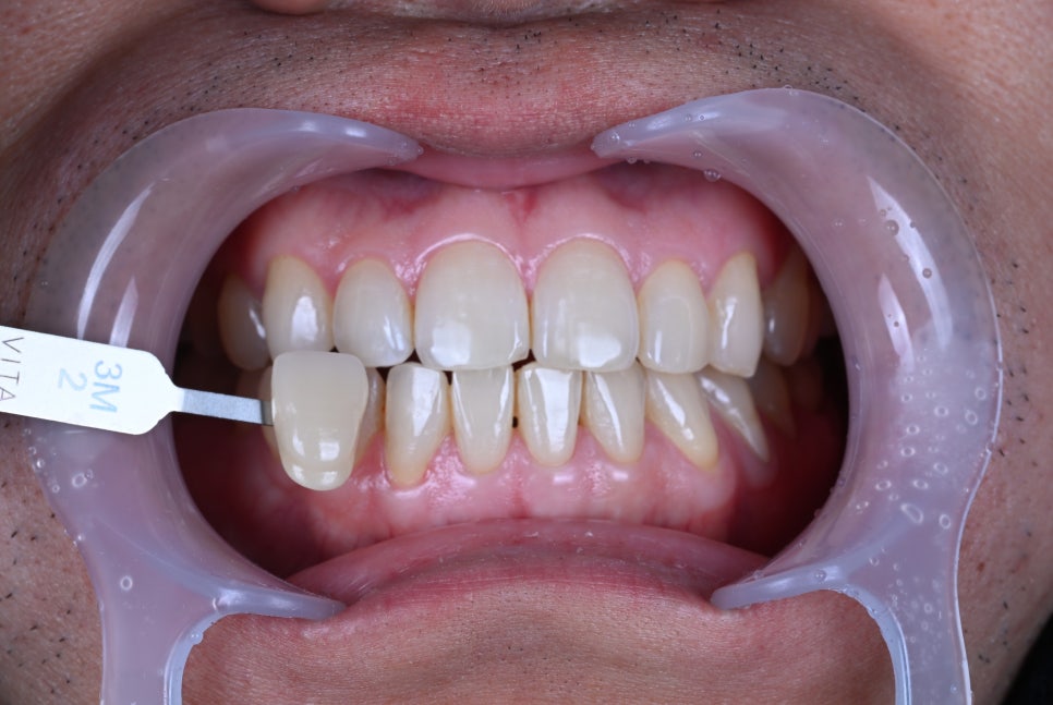 강남치아미백, 선릉치아미백 리얼 후기 관련 이미지 1