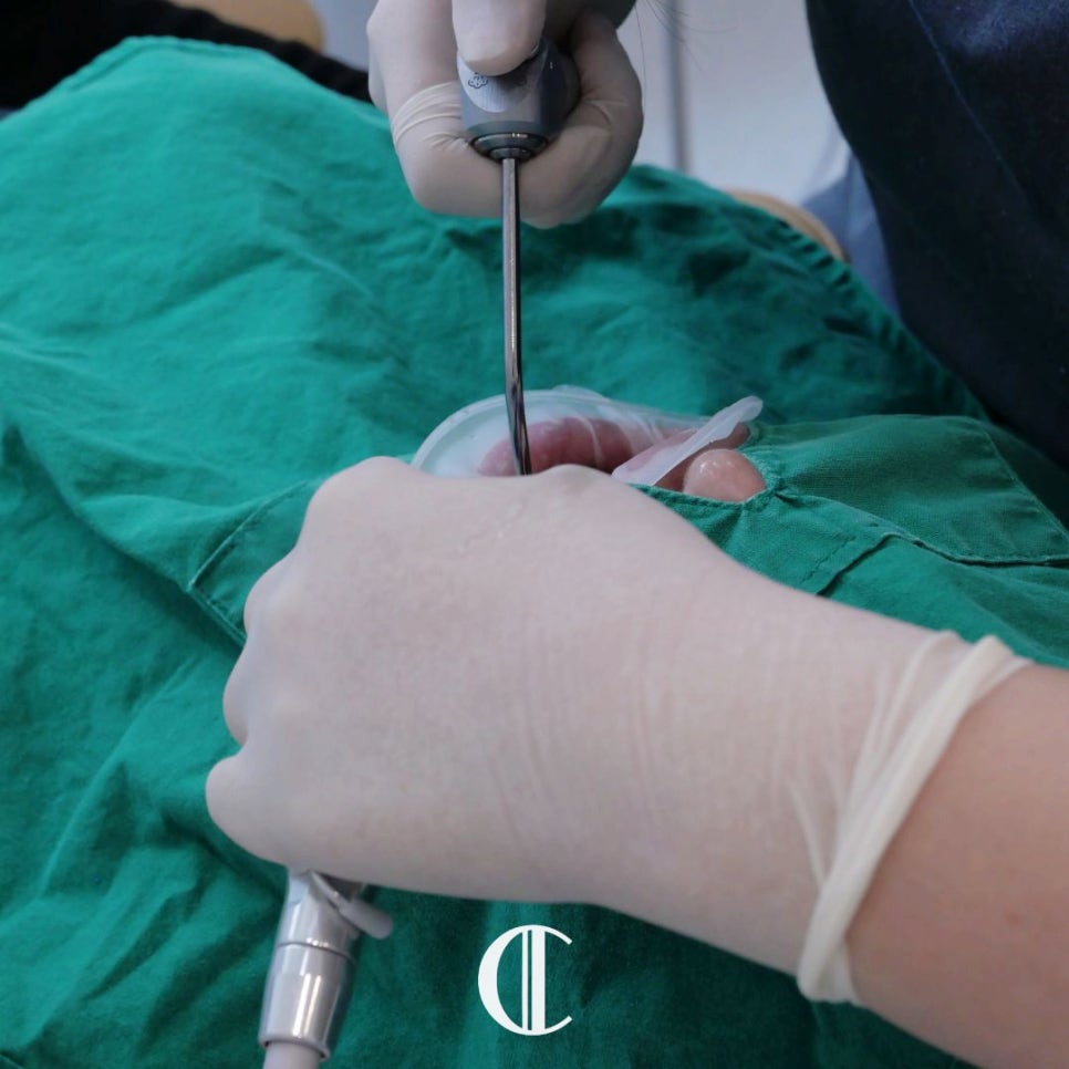 Eonju Station Dental Clinic: For Laminate Veneer Retreatment, Do the Teeth Have to Be Filed Down Again? image 9